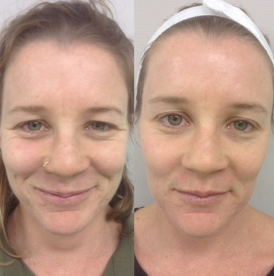 שינה מרגיעה | כרית CloudAlign + ציפית קירור חינם - כרית צוואר ארגונומית + ספוג זיכרון בגובה כפול עם ציפית קירור לישנים על הצד, הגב והבטן הכרית הטובה ביותר לשנת 2025 זכתה בפרס 